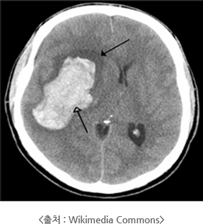 뇌졸중 이미지 출처: Wikimedia Commons