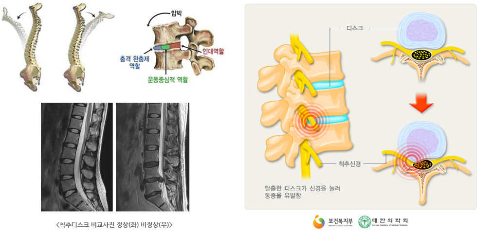 척추디스크 비교사진 정상(좌) 비정상(우) 이미지, 탈출한 디스크가 신경을 눌러 통증을 유발하는 척추디스크 이미지