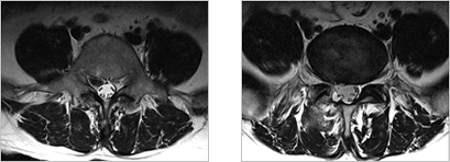 미세현미경하 디스크 제거술 관련 척추 사진